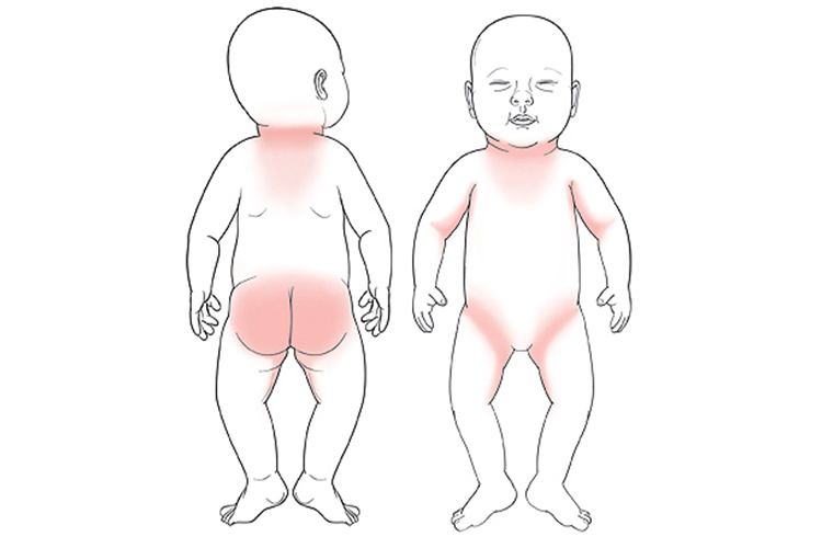 عرق سوز شدن در نواحی مختلف بدن